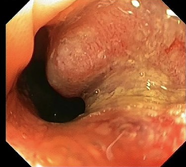 Colonoscopy of the sigmoid colon revealing a polyp suspected for malignancy.
