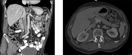 Abdominal contrast-enhanced computed tomography. A. Tumor in the sigmoid colon. B. Four hypodense lesions in liver suspected for metastases.