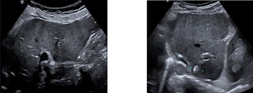 Ultrasonography of the liver showing no progression of disease. A. Right lobe. B. Left lobe.