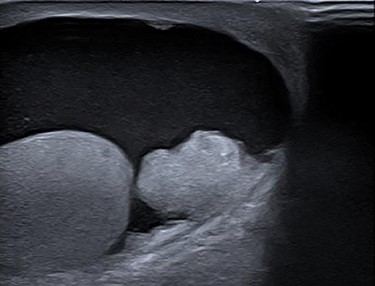 Ultrasonography of right testis showing hydrocele and a tumorous mass.
