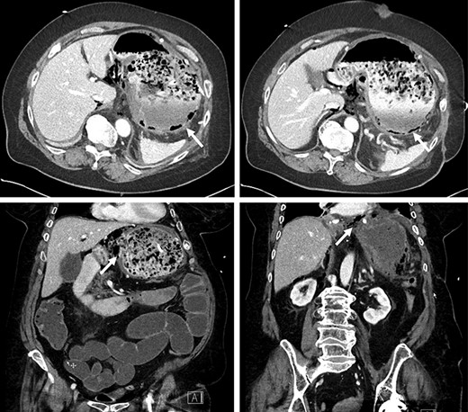 Pneumatosis in the posterior wall and lesser curvature of the gastric cavity on CT scan.