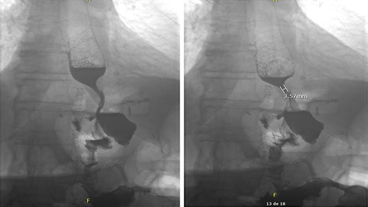 Intact esophagojejunal and jejunojejunal anastomoses on barium swallow.
