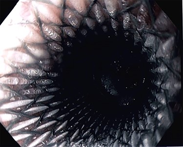 Endoscopic stent at the esophagojejunal anastomotic stricture.