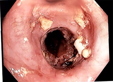 Esophagojejunal anastomosis after removal of the endoscopic stent.