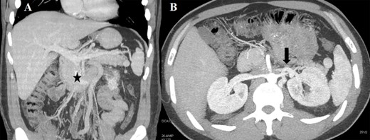 (A) CT scan (coronal section) of the retroperitoneal mass (asterisk) involving the IVC and LRV with congested gonadal vessels; (B) cross-section CT scan showing well-represented collateral outflow (arrow) of the renal–azygos–lumbar system.