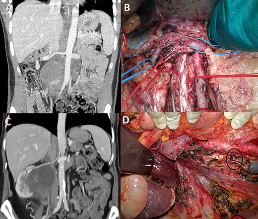 (A) Pre-operative CT scan with a large lesion involving the IVC; (B) intraoperative view showing ligation of the IVC with renal-vein preservation; (C) coronal CT scan with a huge retroperitoneal space-occupying lesion infiltrating the right kidney and occluding the IVC; (D) intraoperative image after right nephrectomy and IVC resection showing a large collateral lumbar trunk (circle).