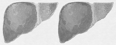 Clinical case 1 – Vicryl® prosthesis involving the left lobe (illustration).