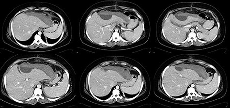 Clinical case 1 – control CT.