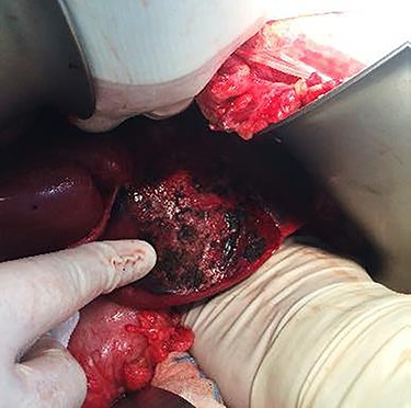 Clinical case 2 – first surgery – hepatic rupture.