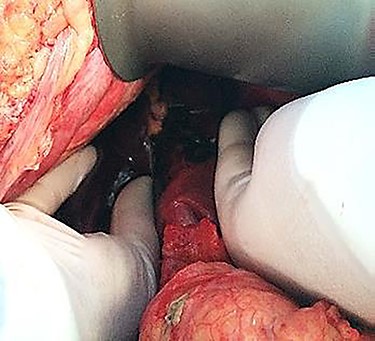 Clinical case 2 – first surgery – hepatic rupture.