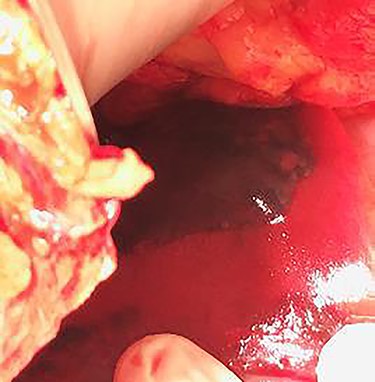 Clinical case 2 – second surgery – hepatic hematoma de novo.