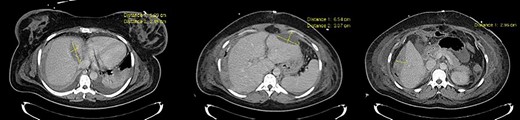 Clinical case 2 – control CT.