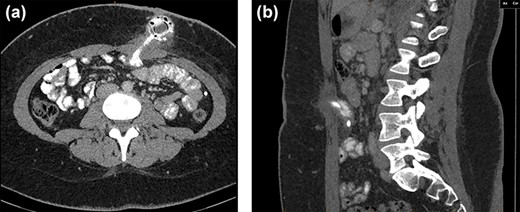 CT axial (a) and sagittal (b) views showing soft tissue thickening surrounding the LAGB port within the subcutaneous tissues of the abdominal wall extending to a segment of small bowel.