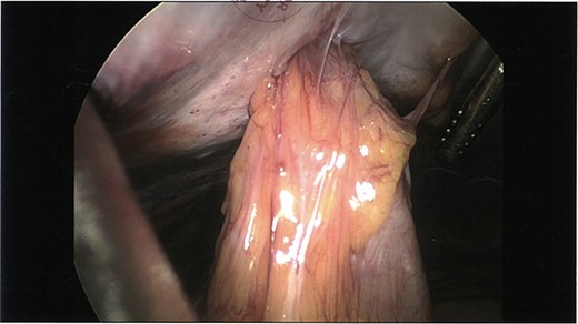Initial laparoscopic view of the loop of small bowel tethered to the anterior abdominal wall.