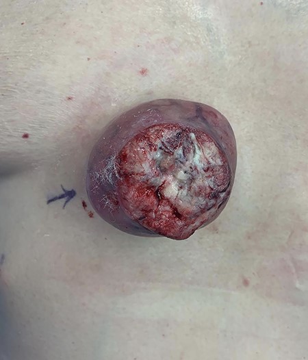 Polypoid cutaneous lesion for excision.
