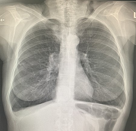 Pre-operative chest X-ray with upper lobe mass.