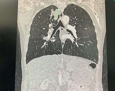 CT of spiculated upper lobe mass.