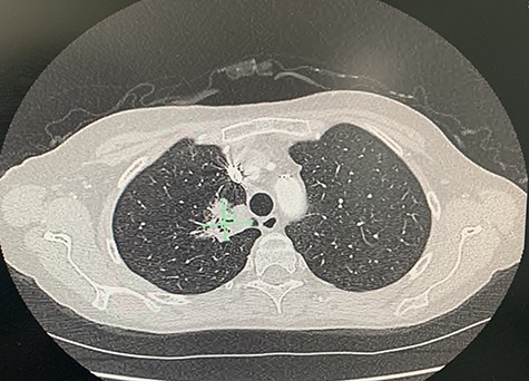 CT of upper lobe mass.