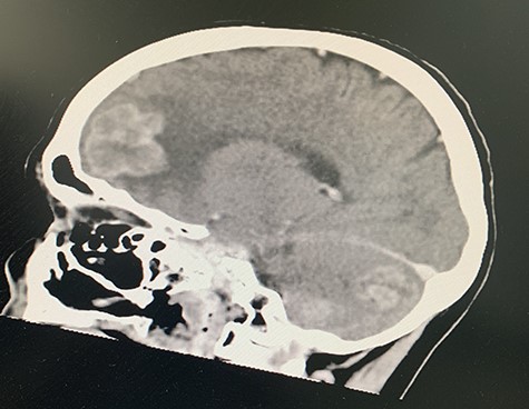 CT of cerebral lesions.