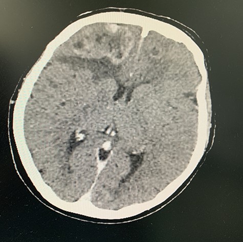 CT of cerebral lesions and midline shift.