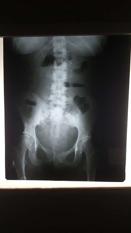AXR shows air-fluid levels within the transverse colon and absence of gases in the pelvis.