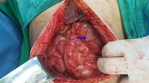 Red arrow indicates to the small intestine and blue arrow indicates to the colons.