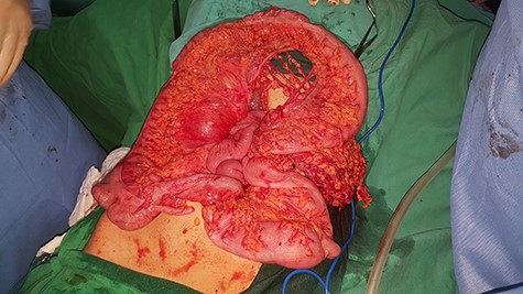 Small intestinal entrapped within a congenital transmesocolic hernia.