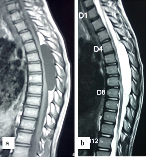 Sagittal T1 (a)- and T2 (b)-weighted MR images showing a large cystic lesion at T4–T8 compressing the spinal cord.
