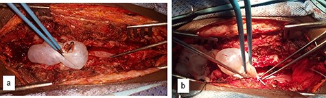 Intraoperative images showing dissection of the cyst from the dura (a) and the point of communication with the subarachnoid space (arrow) (b).