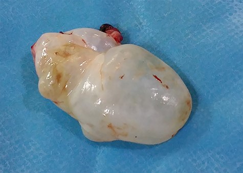 The excised cyst.