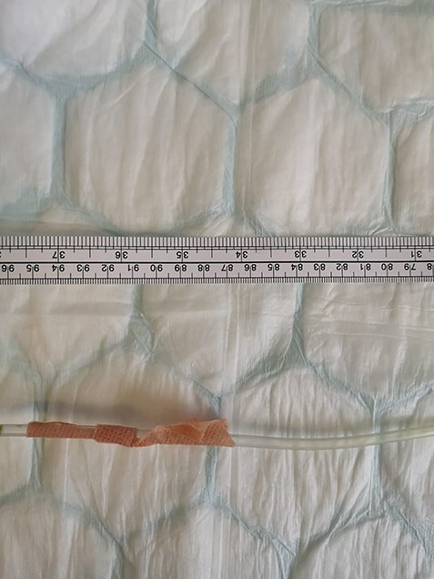 Photo showing NGT proximal end taped to the nose at 95 cm.