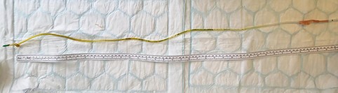 Photo showing whole NGT.