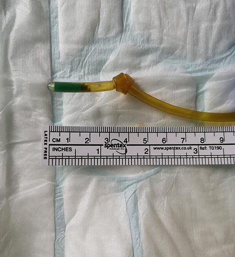 Photo showing the knot 4 cm from NGT distal end.