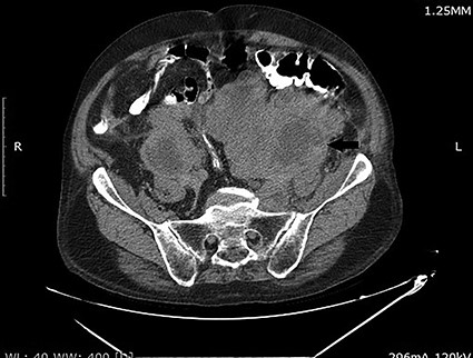CT scan of the abdomen and pelvis demonstrating a large retroperitoneal mass (arrow).
