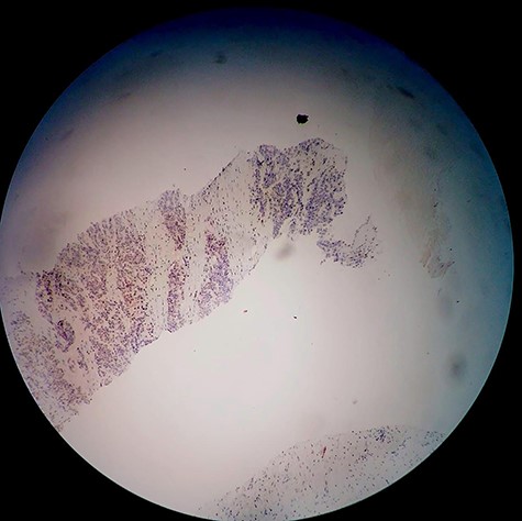 Immunohistochemical examination of the retroperitoneal mass core needle biopsy using the PSA stain.
