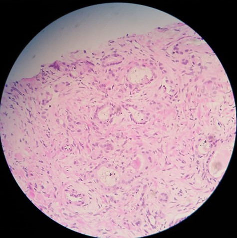 Prostate needle biopsy specimen showing prostate adenocarcinoma.