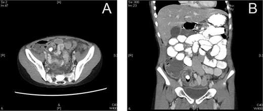Preoperative CT scan (axial section) showing a dilated appendix with an enhanced wall filled with fluids and air pockets (A). A large appendicolith was noted. The coronal section shows a dilated appendix with an enhanced wall filled with fluids and air pockets. A large appendicolith was noted (B).