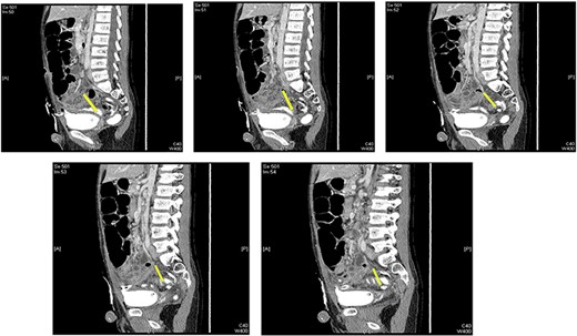 Multiple sagittal views showing the drain penetrating the urachus.