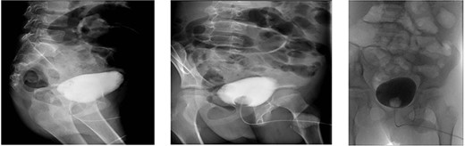 Cystogram performed on postoperative day 8 showed no extravasation of the contrast material.