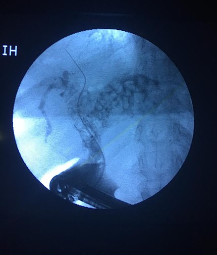 On table, cholangiogram showing extent of biliary stones.