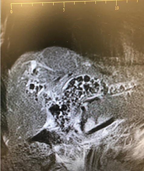 MRCP showing extent of biliary stones.