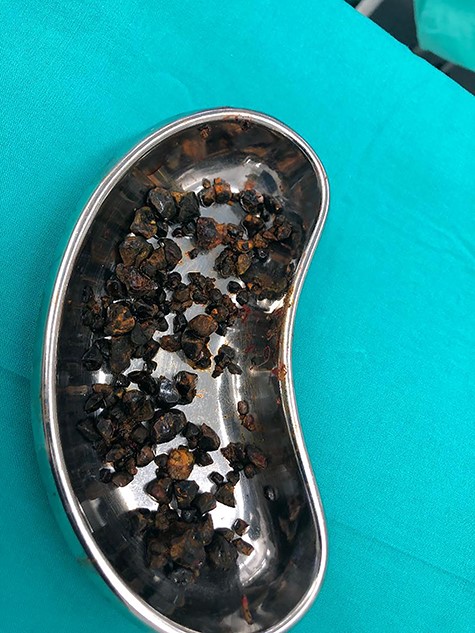 Biliary stones extracted during open surgery.