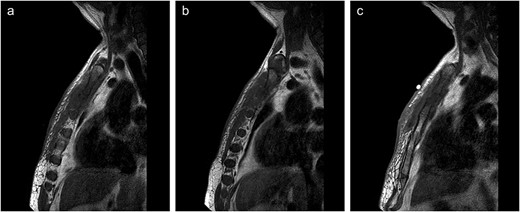 (a–c) Lateral views of sternal MRI showing varying degrees of inflammation and septic arthritis of manubriosternal joint.