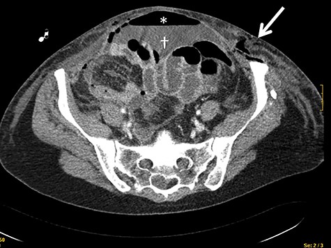 CT scan showing the presence of air in the abdominal wall (arrow) and pneumoperitoneum (asterisks) and intrabdominal liquid (dagger).