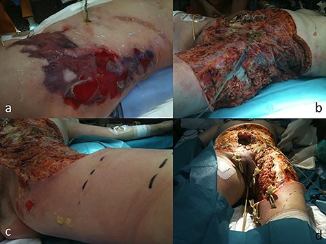 Case 1 (a) Skin lesions observed in the ICU before the surgery. (b) Final image after debridement. At this stage of the procedure, it was not technically possible to close the patient’s abdominal wall. (c) Left leg extension after 24 hours after the first procedure. (d) Abdominal wall and leg once in the plastic and reconstructive surgery before the skin grafts.