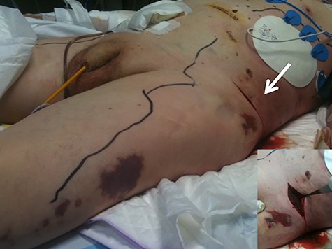 Case 2. Image showing the extension of the fasciitis along the abdomen and legs. Many incisions were made over the patient’s abdominal wall, revealing extensive necrotic tissue (arrow).