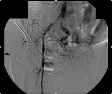 Aortogram demonstrating occlusion of left distal hypogastric, external iliac and common femoral arteries, as well as right hypogastric artery