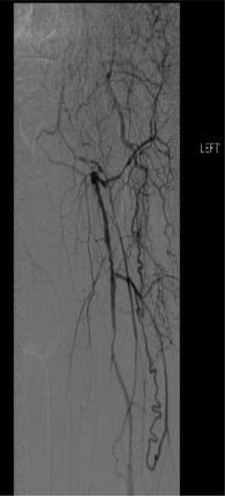 Selective left lower extremity angiogram demonstrating patent mid-to-distal profunda femoris artery and its collaterals