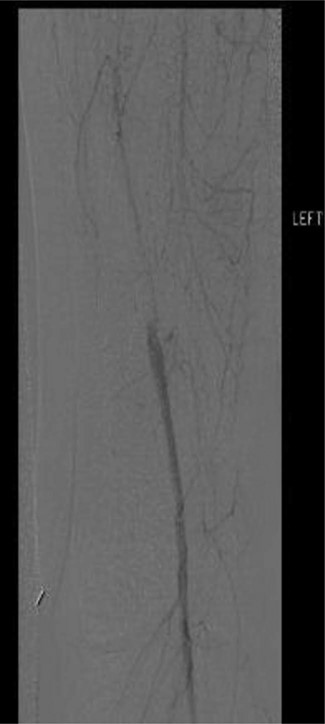 Selective left lower extremity angiogram demonstrating reconstitution of the above-knee popliteal artery at the adductor canal