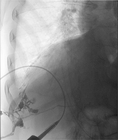 Contrast study of the broncho-pleuro-cutaneous fistula formed by the dropped gallstone